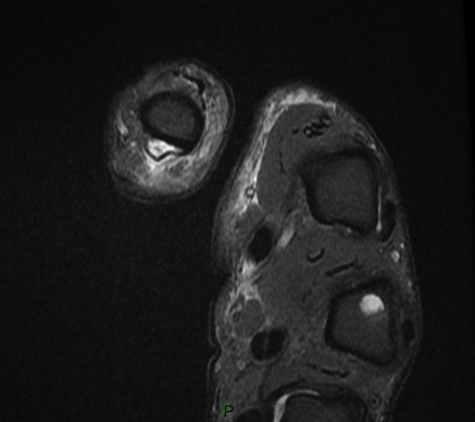 Figure 2 for case Flexor pollicis longus tendon ( RID2383 ) laceration